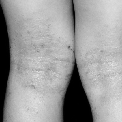 User-submitted photo of skin behind the knees for Case 01