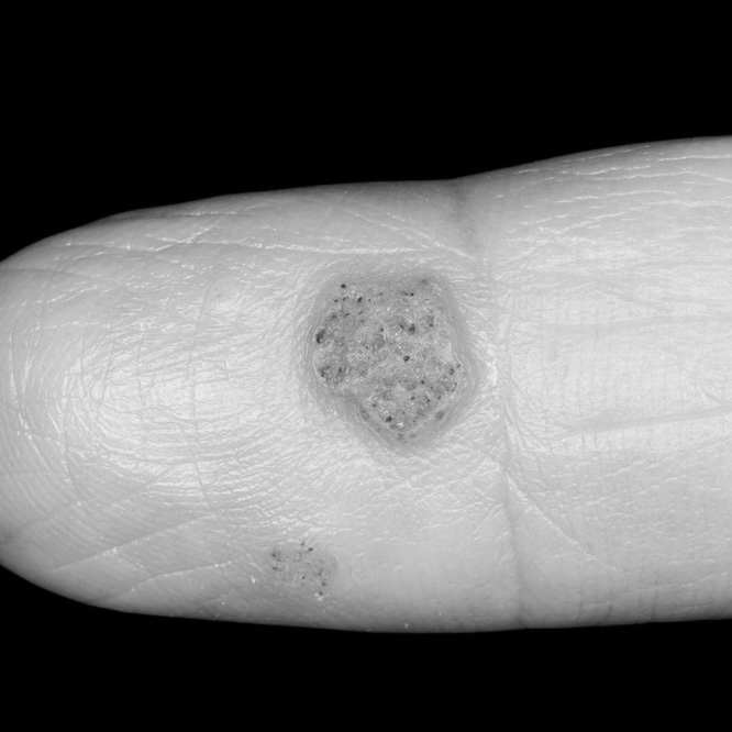 User-submitted photo of a raised lesion on a finger for Case 02